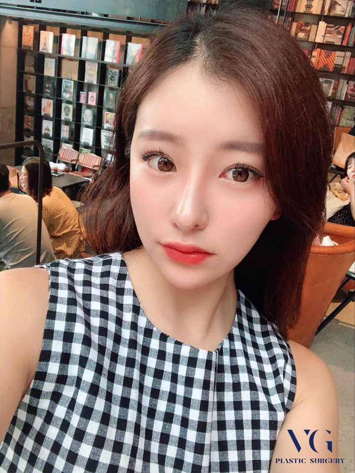 이마거상술로 깊은 이마주름과 처진 눈을 한번에~! 관련 이미지 5