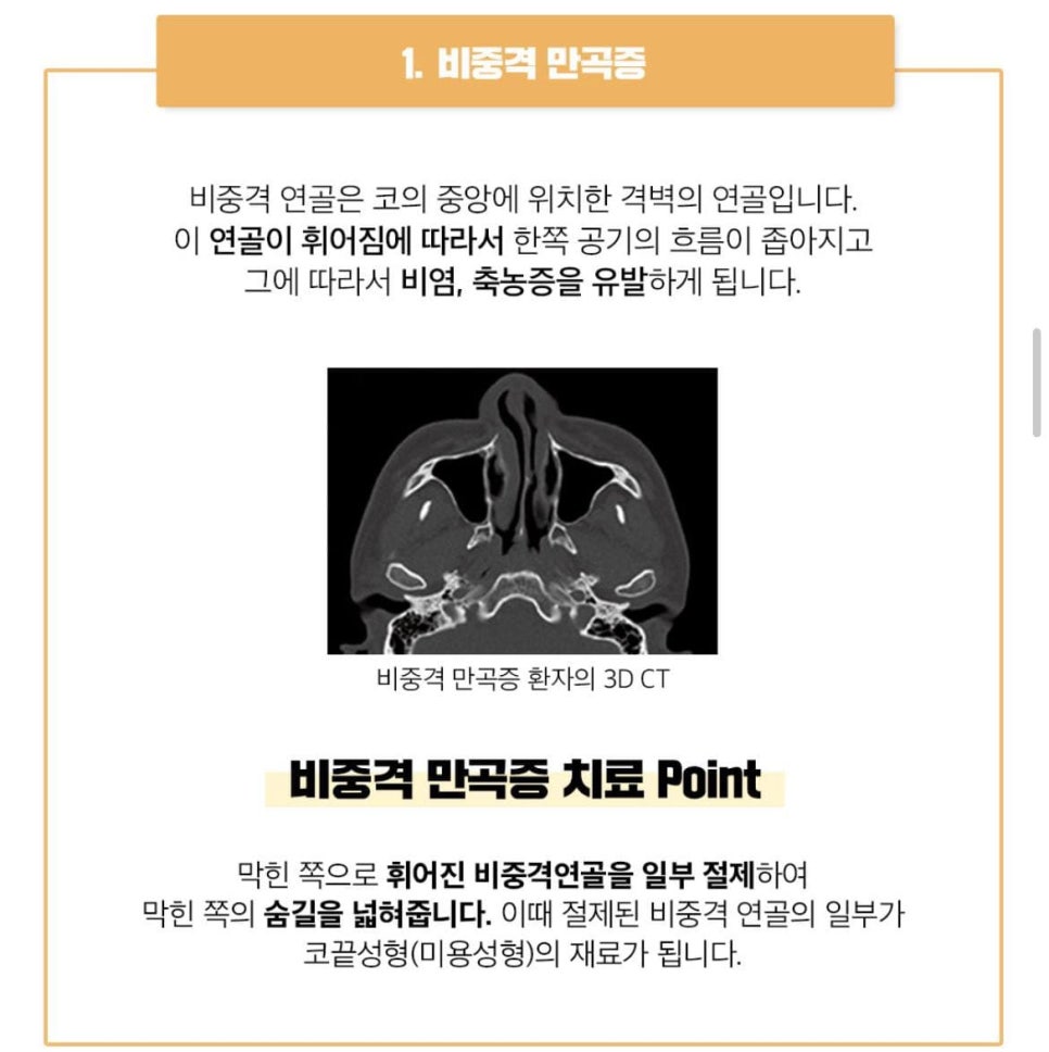 치료와 성형을 한번에[베리굿한 비염코성형] 관련 이미지 3