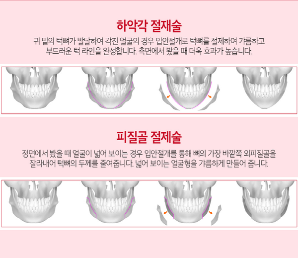 안면윤곽3종 매끄러운 얼굴라인의 비결? 관련 이미지 3