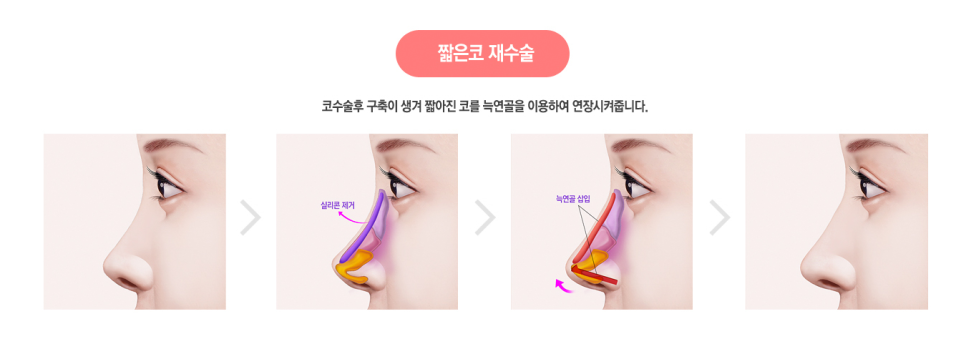 베리굿성형외과의 VERYGOOD한! 자가늑코재수술 전후 관련 이미지 5