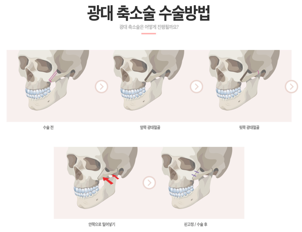 베리굿&hearts;얼굴에 찰떡! 베리굿 광대축소 관련 이미지 5