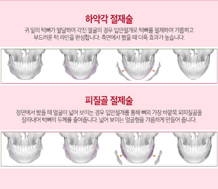 안면윤곽 매끄럽고 아름답게! 관련 이미지 3