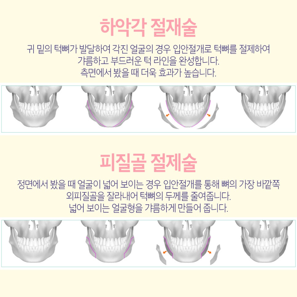 안면윤곽 재수술 어디로 가야할까? 관련 이미지 6