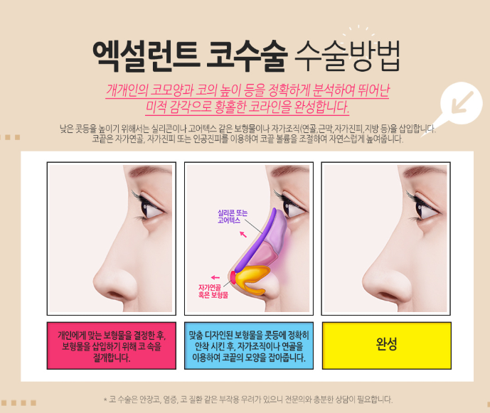 베리굿성형외과, 엑설런트 코성형! 임영민원장님의 노하우! 관련 이미지 4