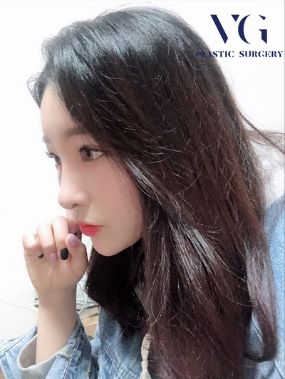 지방이식잘하는곳 입체적으로 아름답게! 관련 이미지 1