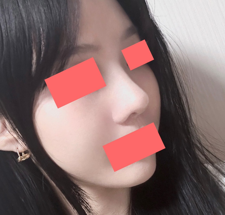 첫코수술 절골 기증늑연골 비중격교정술 하비갑개절제술 베리굿성형외과 코수술 후기 관련 이미지 3