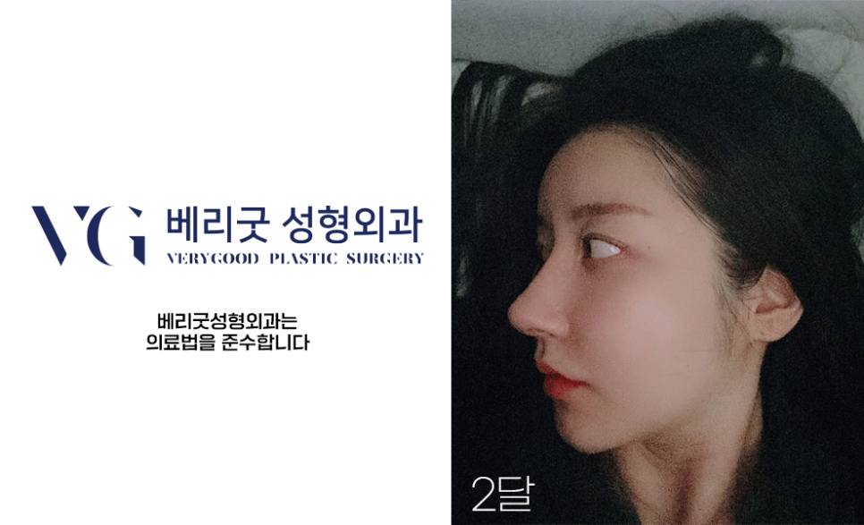 화려한 코라인, 베리굿성형외과 자가늑코성형✨ 관련 이미지 9