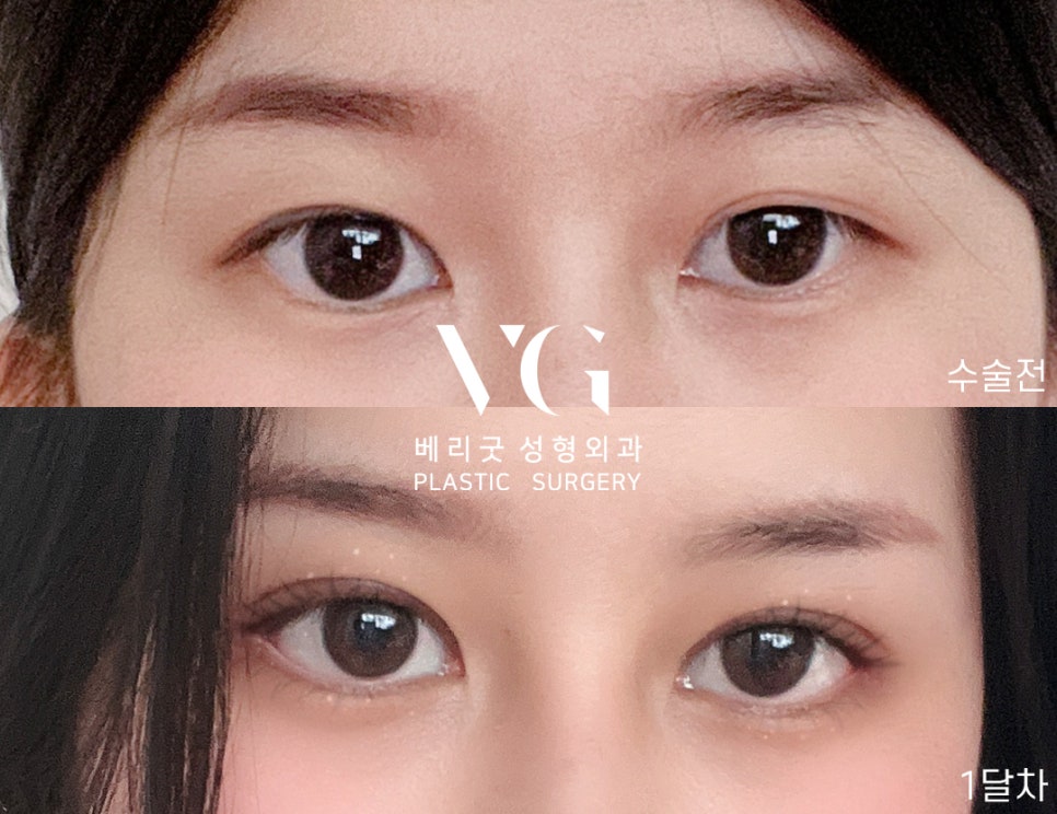 마지막은 쌍수는 베리굿에서 블링블링하게 베리굿 눈재수술전후👀✨ 관련 이미지 7