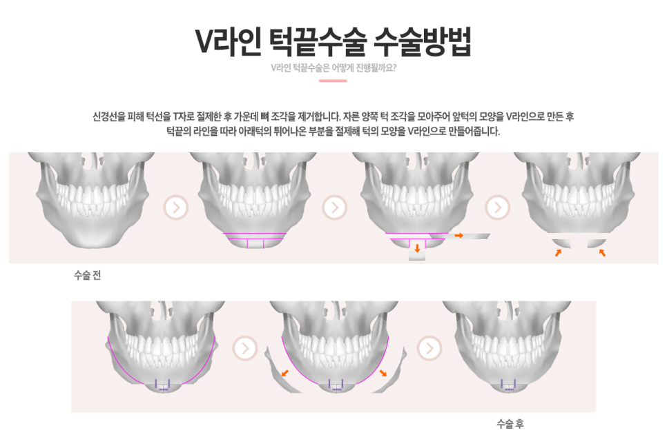 V라인 턱끝성형✌ 윤곽수술도 역시 베리굿성형외과 관련 이미지 4