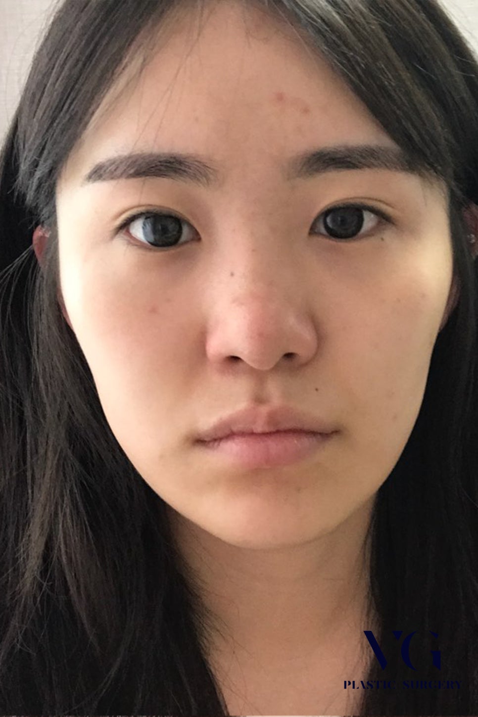 자연유착 쌍꺼풀수술, 마치 내 것 같은 자연스러움 관련 이미지 1