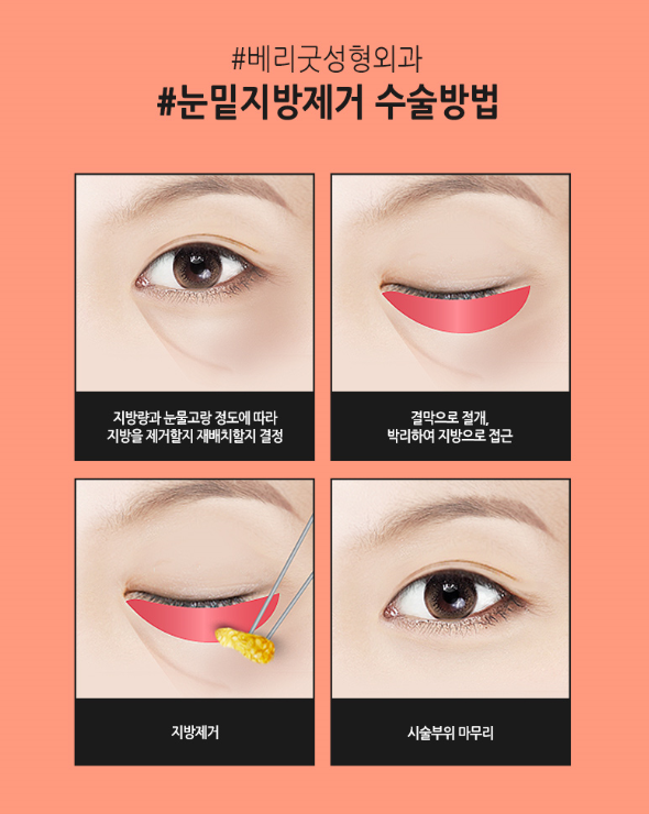 눈밑지방제거, 칙칙하고 그늘진 눈밑 베리굿성형외과에서! 관련 이미지 4