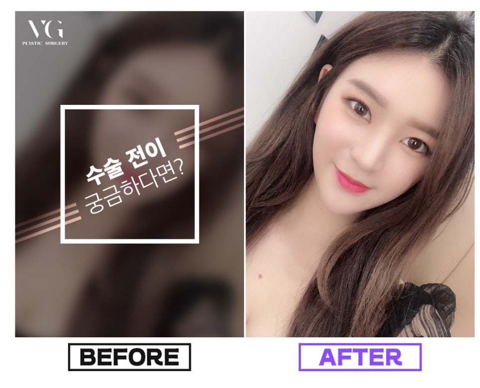 얼굴지방흡입으로 갸름한 v라인으로! 관련 이미지 9