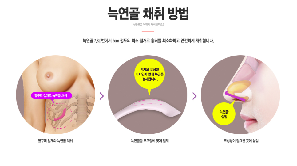 베리굿성형외과의 VERYGOOD한! 자가늑코재수술 전후 관련 이미지 3