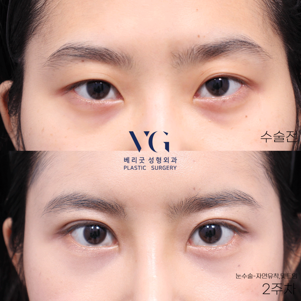 베리굿하게💖베리굿성형외과 눈성형전후 관련 이미지 6