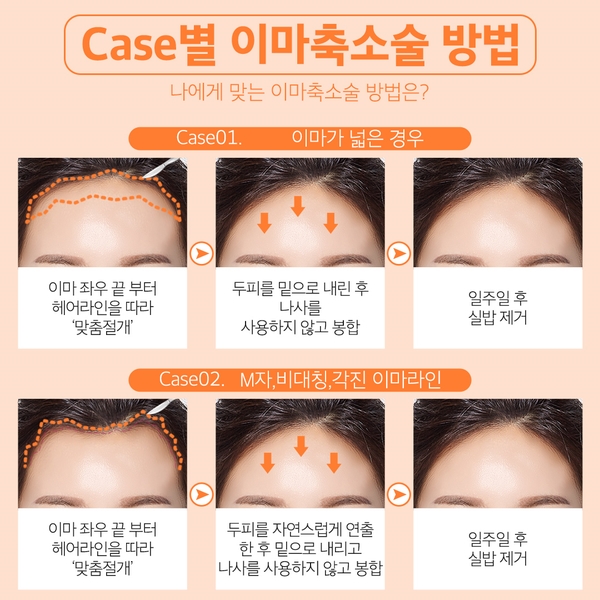 이마축소로 이상적인 이마높이로! 관련 이미지 6