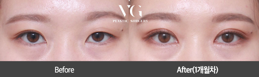아름다움을 위한 시작, 베리굿성형외과 눈 성형(자연유착) 관련 이미지 7