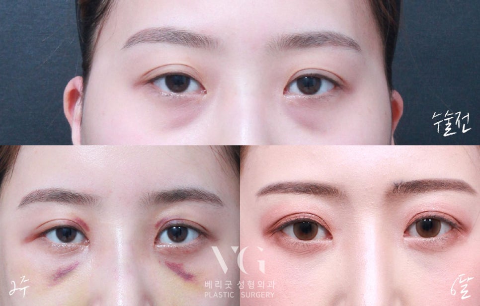다크서클 없애는 눈밑지방재배치(눈밑지)베리굿성형외과 전후✨ 관련 이미지 3
