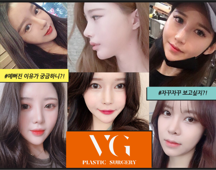 나의 마지막 눈성형 쌍꺼풀재수술! 어디에서 해야할까?? 관련 이미지 12