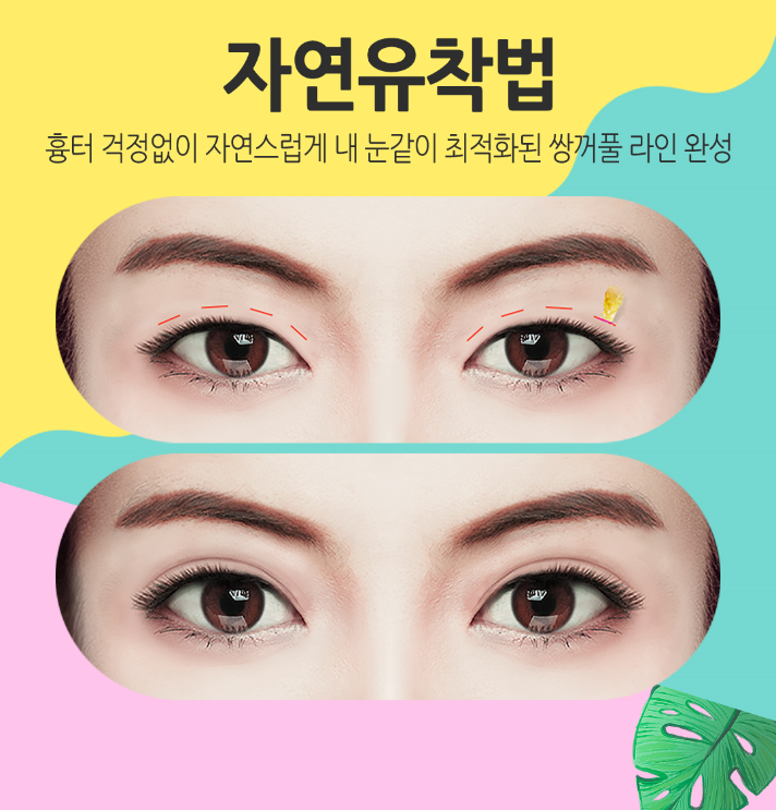 눈성형잘하는곳 내게 맞는 눈매라인에 맞게 관련 이미지 6