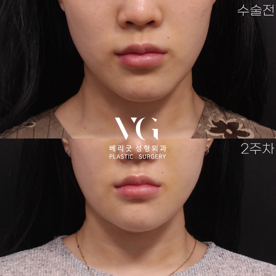 VERY GOOD LINE✨ V라인 턱끝축소 REAL전후 관련 이미지 7