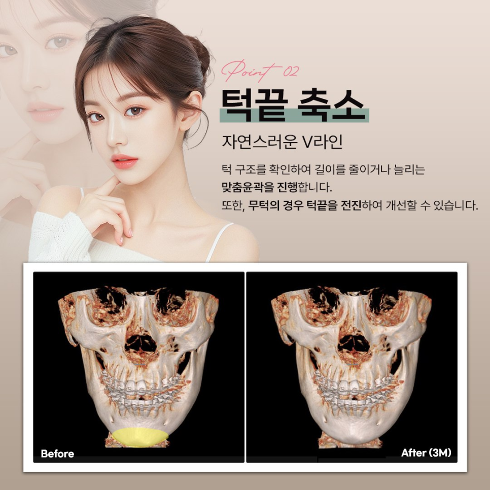 안면윤곽 수술 전 체크해야 할 3D-CT 정밀 분석의 중요성 관련 이미지 4