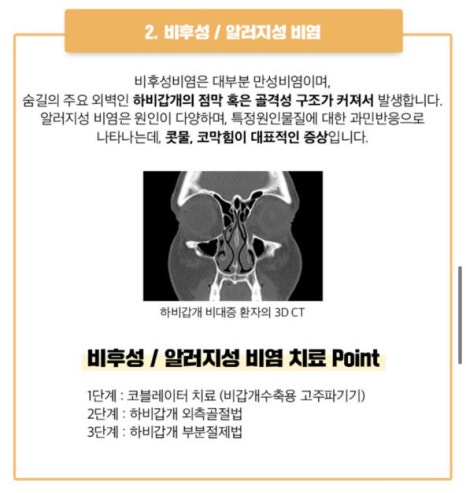 베리굿 비염코성형✨비염수술과 코성형을 동시에? 관련 이미지 5