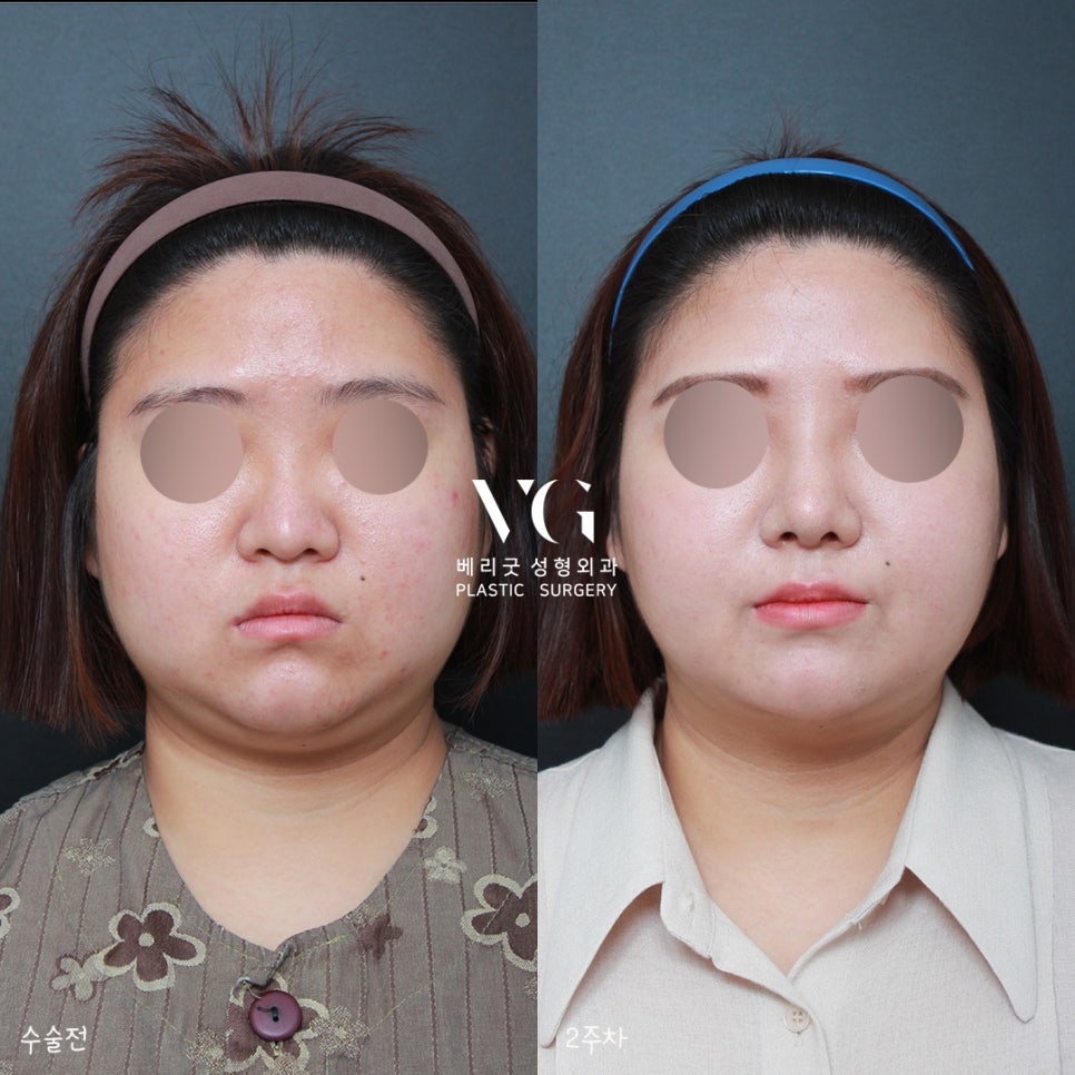 베리굿 얼굴지방흡입 전후💖밖에서 언제까지 마스크 쓸래? 관련 이미지 2