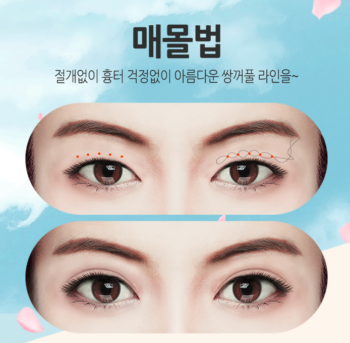 내게 맞는 라인으로 쌍꺼풀수술 잘하는곳 관련 이미지 1