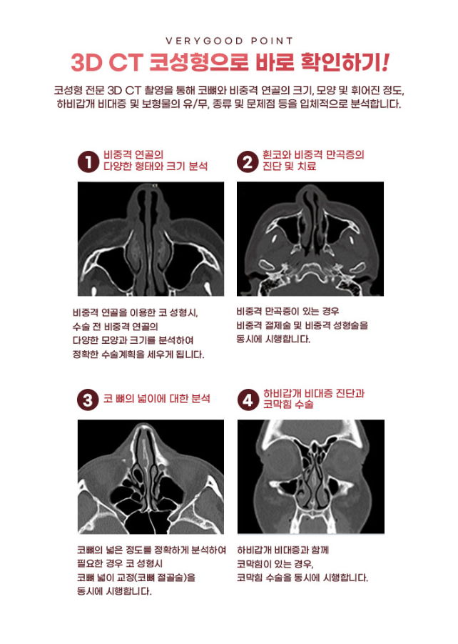 강남 베리굿성형외과 MZ코, 얼굴 비율에 맞춘 1:1 맞춤 코성형 관련 이미지 6