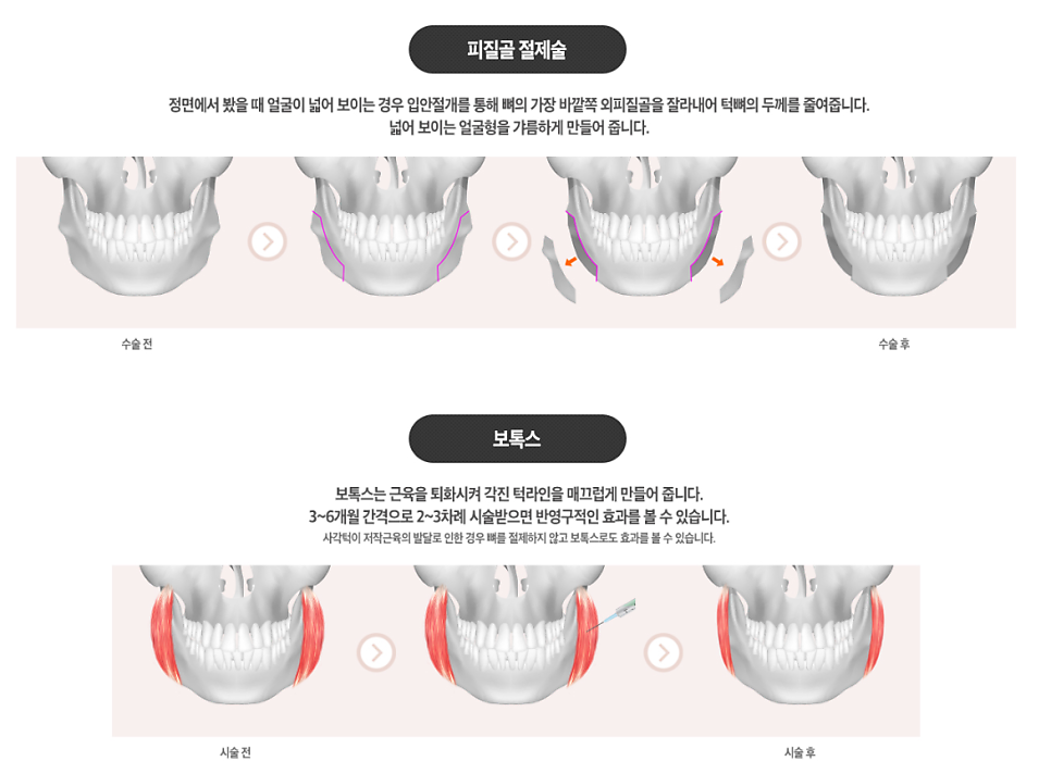 [베리굿성형외과]안면윤곽 리얼전후! 관련 이미지 13