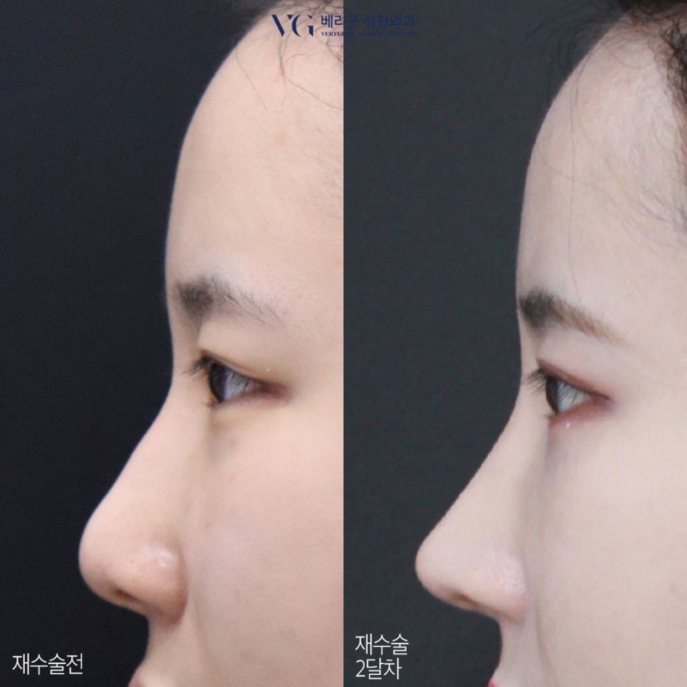 직반코성형? 베리굿성형외과💙 화려하게,자연스럽게✨ 관련 이미지 3