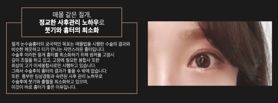 장원영 쌍커풀라인 세미아웃 눈성형 , 나한테도 어울릴까 관련 이미지 8