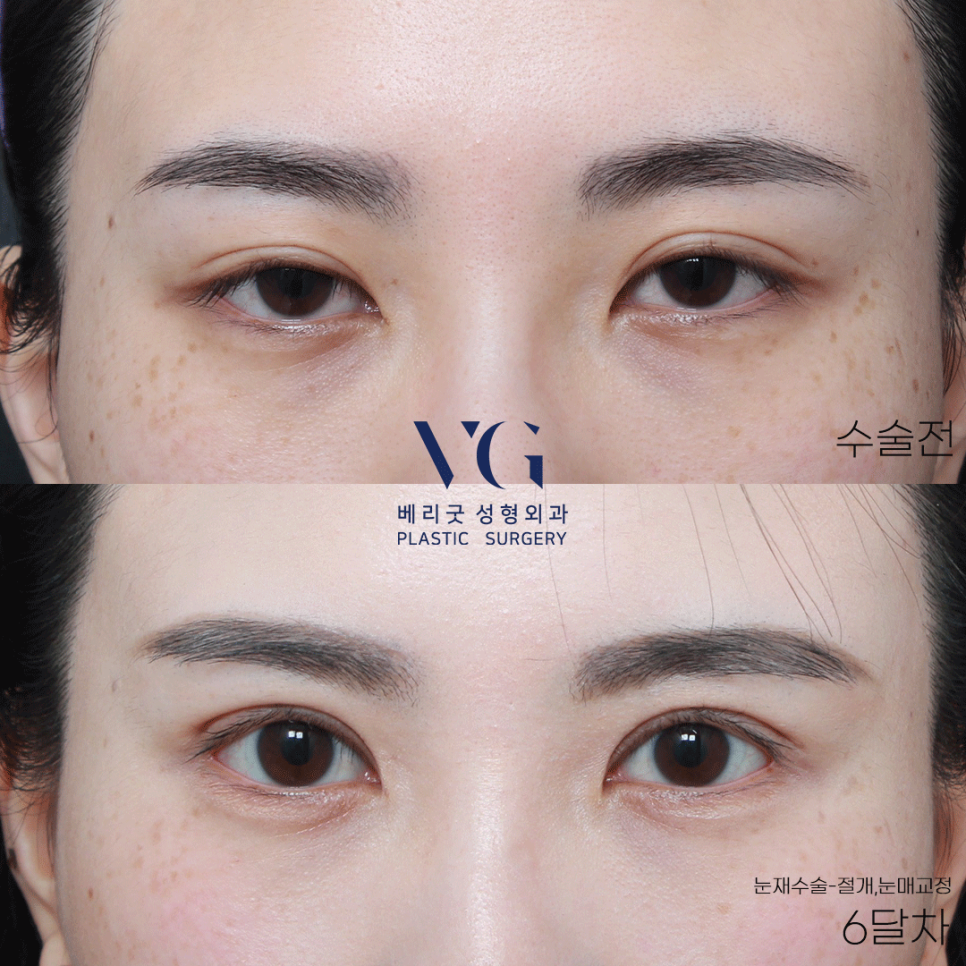 베리굿하게💖베리굿성형외과 눈성형전후 관련 이미지 4
