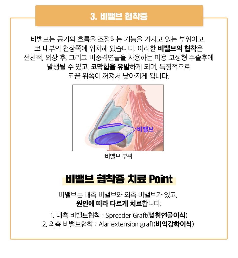 비염코성형 원인 파악부터 비용까지 관련 이미지 7