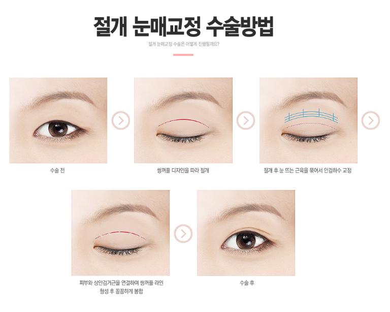 잘생김이 10배가 되는 베리굿 남자 눈매교정 관련 이미지 4