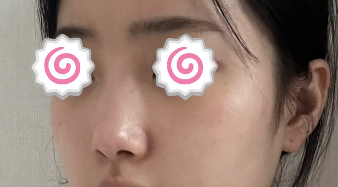 첫코수술 낮은코수술 자가늑연골 귀연골 베리굿성형외과 전후후기 관련 이미지 1
