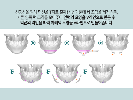 안면윤곽3종 어디서봐도 입체적이고 매끄럽게 관련 이미지 8
