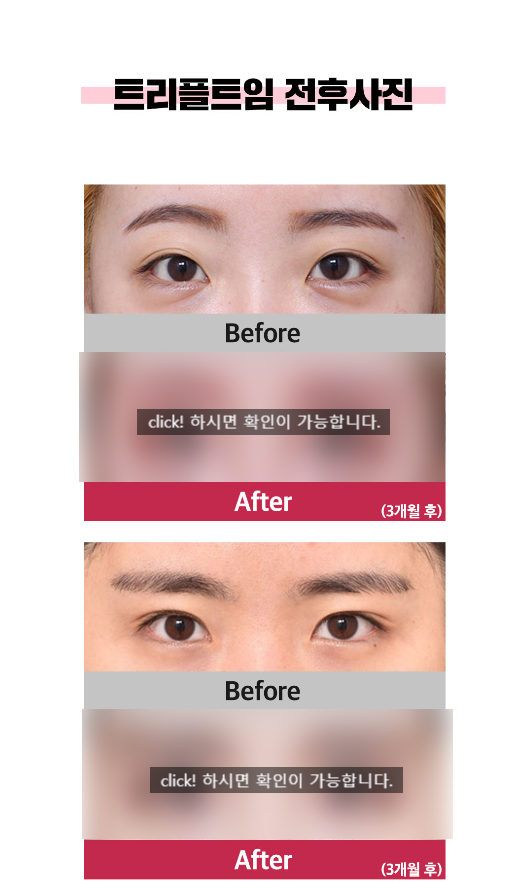 시원한 눈매? 베리굿 트리플 트임 관련 이미지 4