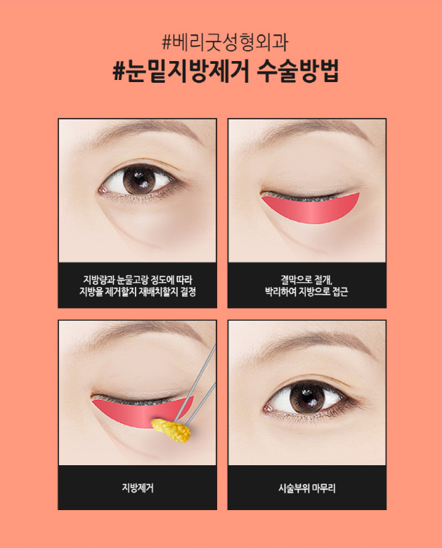 눈밑지방제거하고 환하게 밝히자! 관련 이미지 3