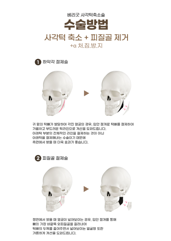 사진 찍을 때마다 넓어 보이는 얼굴, 강남 사각턱축소술이 필요한 순간 관련 이미지 3