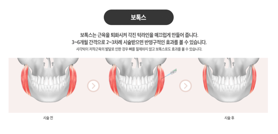 베리굿&hearts;얼굴에 찰떡! 베리굿 사각턱축소 관련 이미지 5