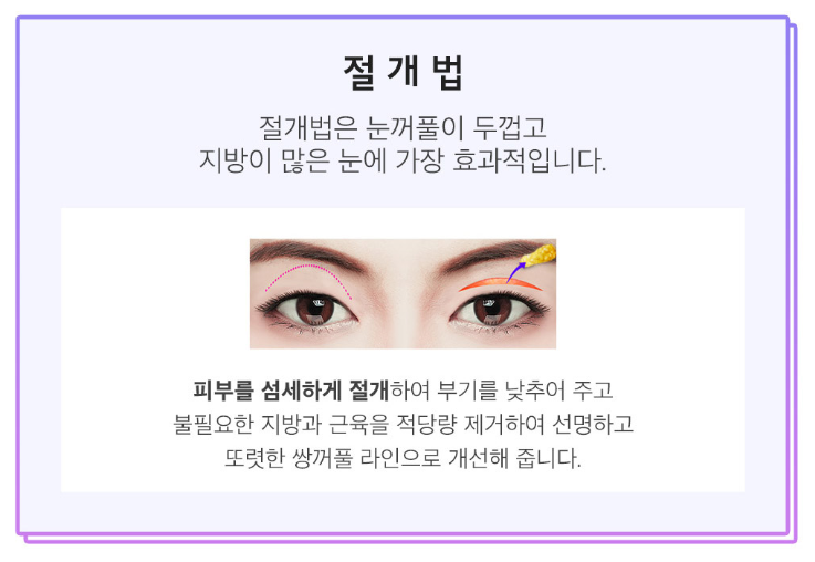 쌍꺼풀수술 비용부터 수술방법까지 관련 이미지 8