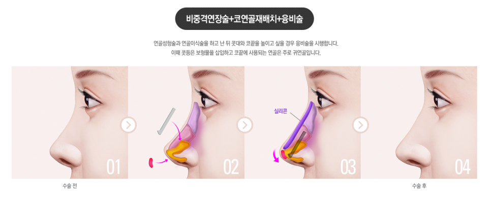 베리굿성형외과 기증늑연골 짧은코교정💖 관련 이미지 10