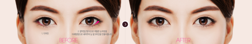 트임성형 시원하고 또렷한 눈매로 개선 관련 이미지 4