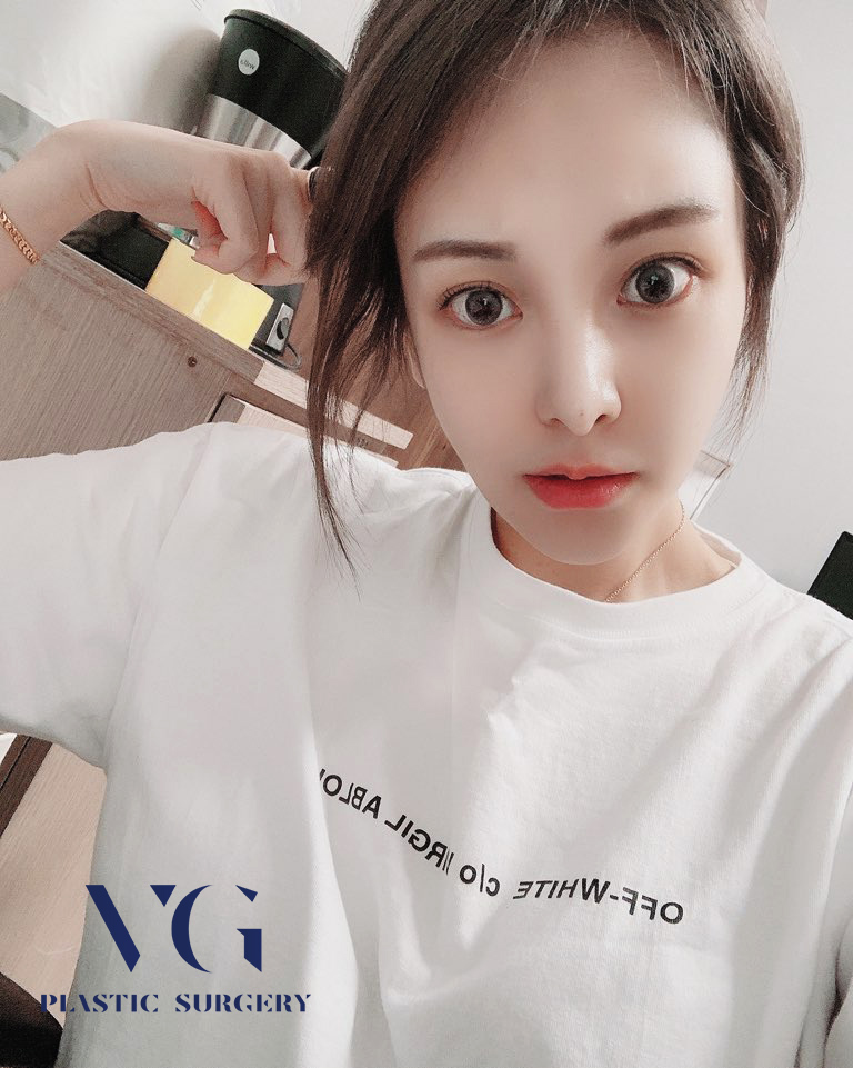 광대축소술 작고 부드러운 얼굴라인 관련 이미지 1