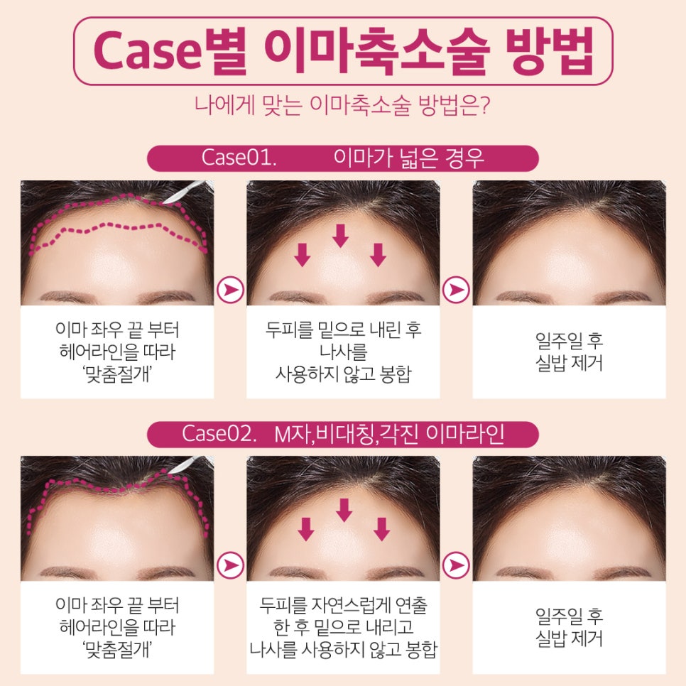 이마축소로 이상적인 이마라인 만들자! 관련 이미지 5