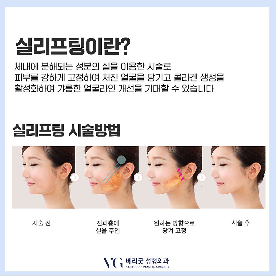 중년 여성 실리프팅, 안면거상술｜얼굴 주름 및 심부볼 처짐 개선! 관련 이미지 6