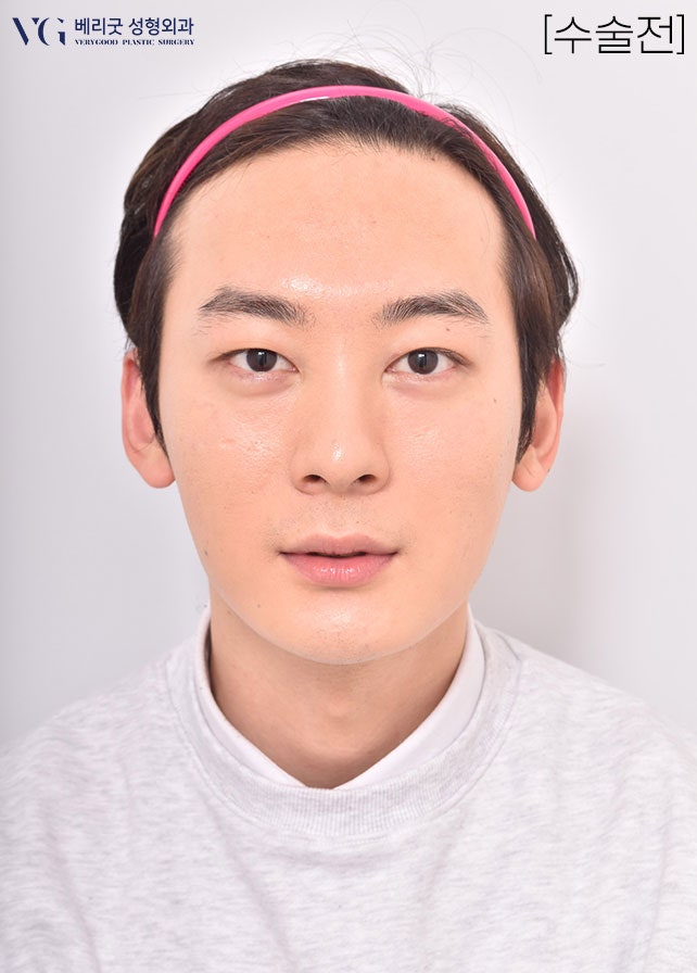 [베리굿성형외과]안면윤곽 리얼전후! 관련 이미지 9