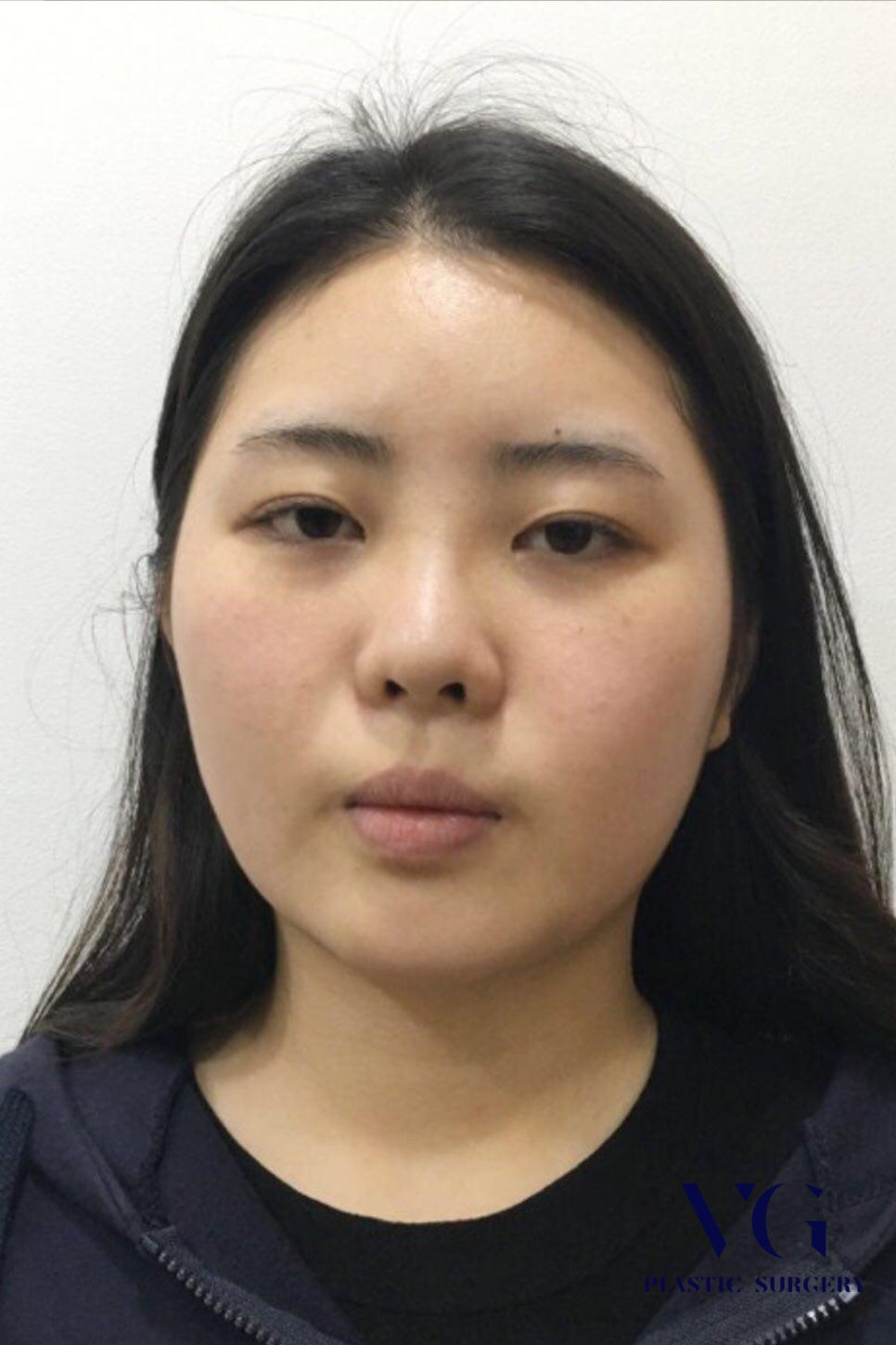 얼굴지방흡입, 후기 확인하고 성공적으로! 관련 이미지 2