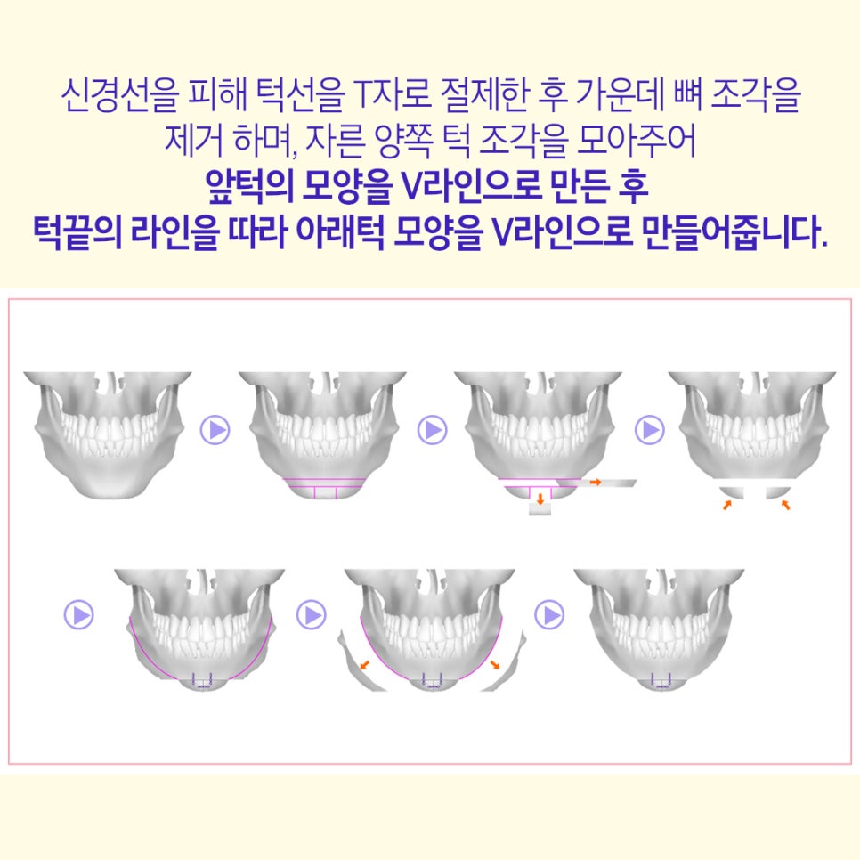 베리굿 안면윤곽3종으로 예쁜 얼굴형으로! 관련 이미지 8